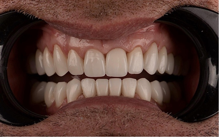 Veneers 5