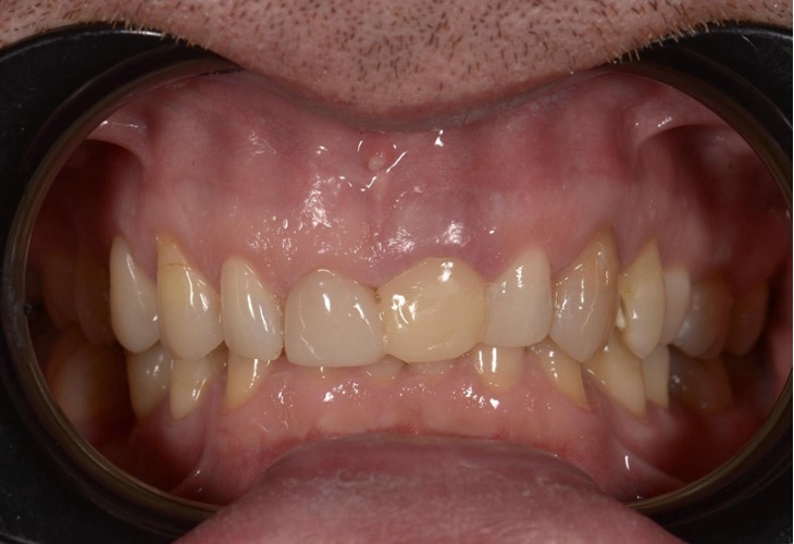 Veneers 4