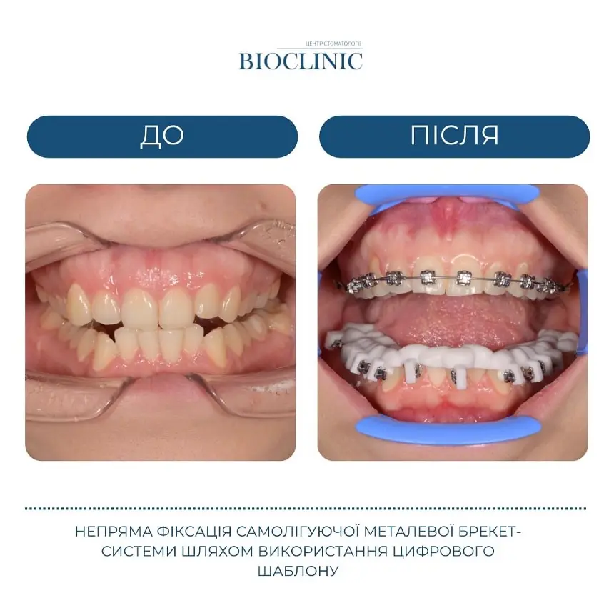 
Installation of braces
What are the stages of installing braces and their features
