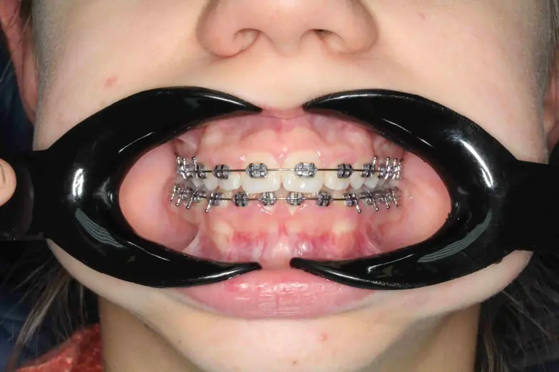 Real photos of braces
Photos of patients with braces who chose the 